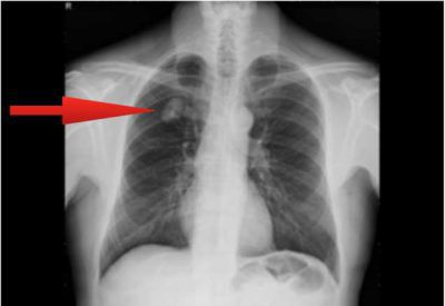 a tüdő tuberkulózisának elsötétülése