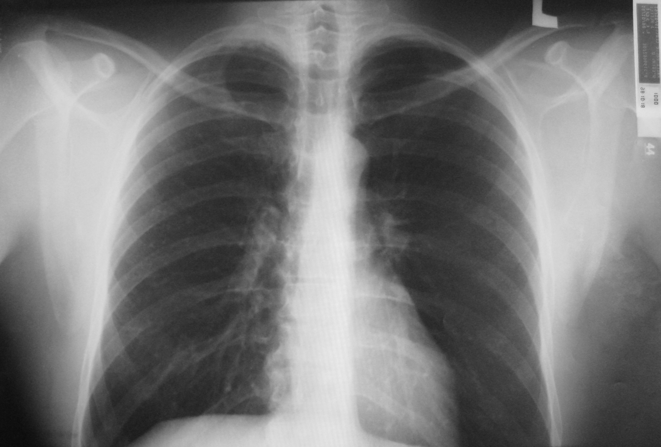 Рентген снимок здоровых легких