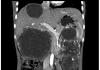 造影剤を使用した腹腔の CT スキャン: 準備、手順、結果