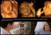 Veszélyes az ultrahang vizsgálat a terhesség korai szakaszában?