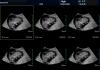 妊娠中の経膣超音波検査：通過の特徴