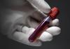 Kaip ruošiatės duoti kraujo paciento biocheminei analizei?